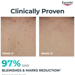 Eucerin DermoPure Clinical Correcting Body Cream 200ml Hot