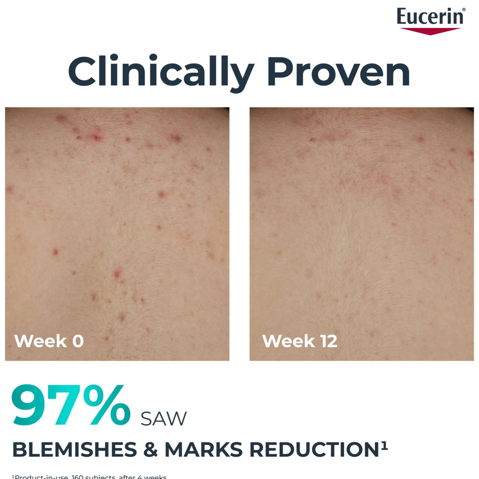 Eucerin DermoPure Clinical Correcting Body Cream 200ml Hot